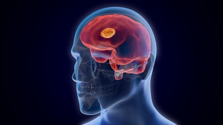 Neurological