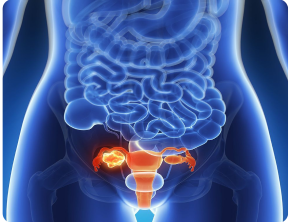 Fibroids